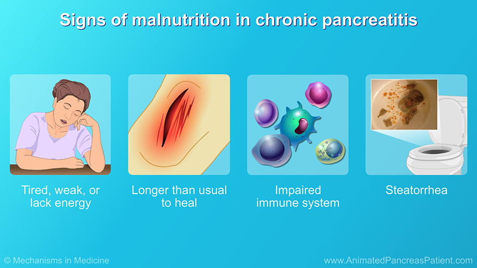 Signs of malnutrition in chronic pancreatitis