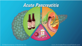 Acute Pancreatitis