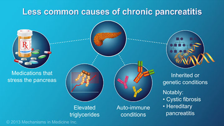 Understanding Chronic Pancreatitis: Causes, Symptoms, and Treatment