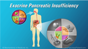 Animation - Exocrine Pancreatic Insufficiency (EPI)