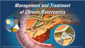 Animation - Management and Treatment of Chronic Pancreatitis