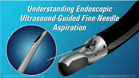 Understanding EUS-FNA