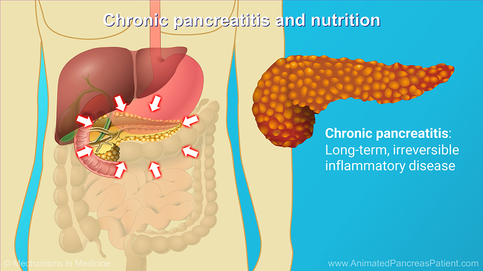 Chronic pancreatitis and nutrition