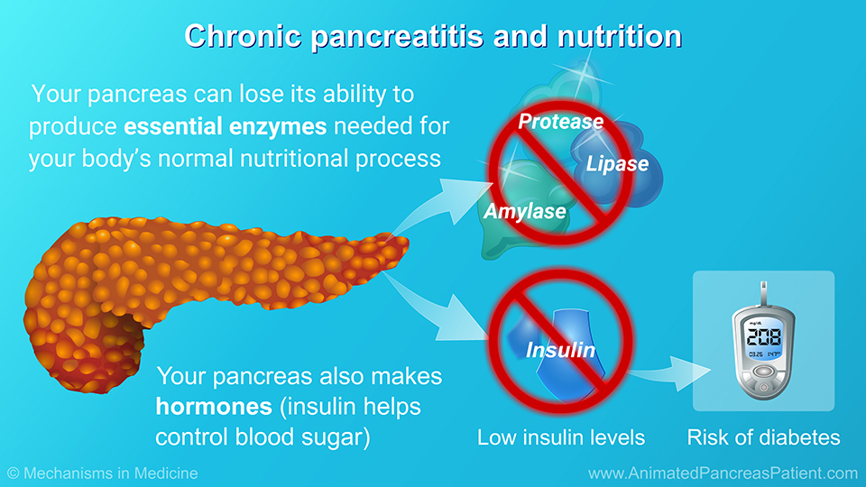 Chronic pancreatitis and nutrition