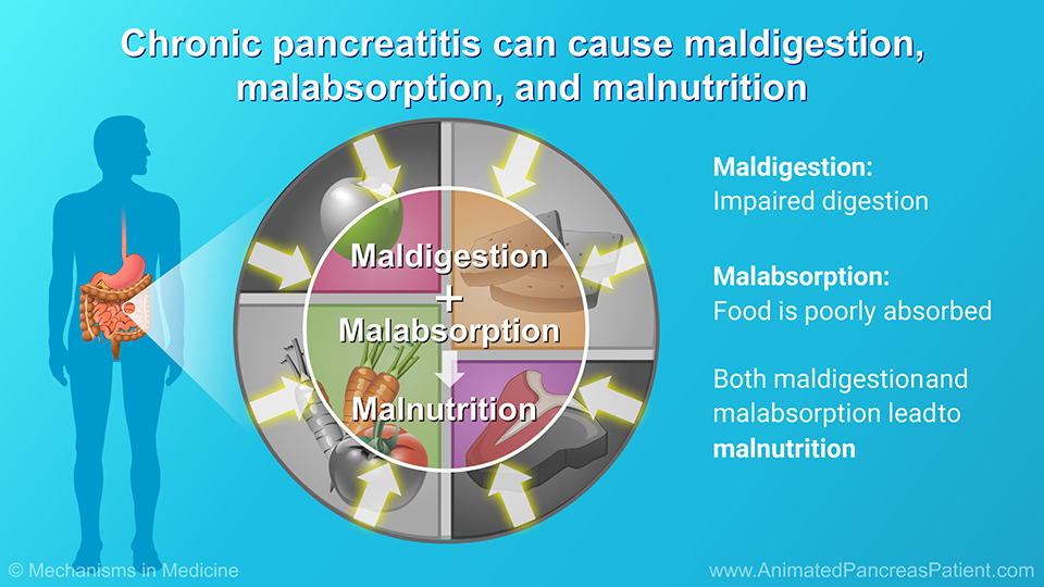 Chronic pancreatitis can cause maldigestion, malabsorption, and malnutrition