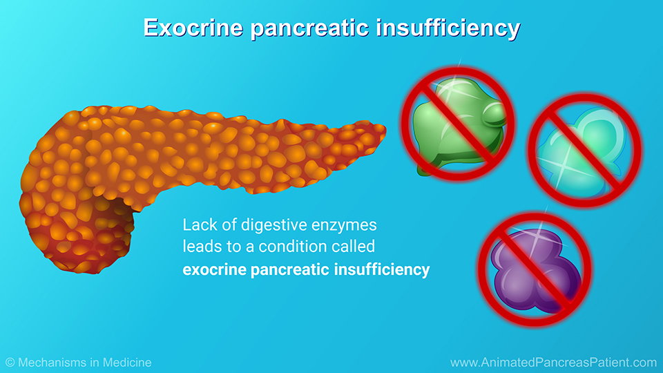 Exocrine pancreatic insufficiency