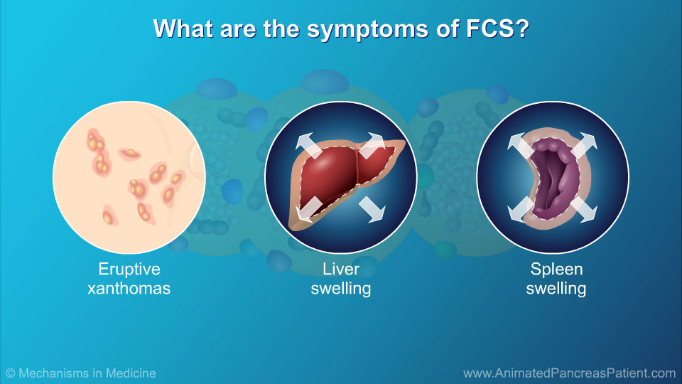 What are the symptoms of FCS? - 2