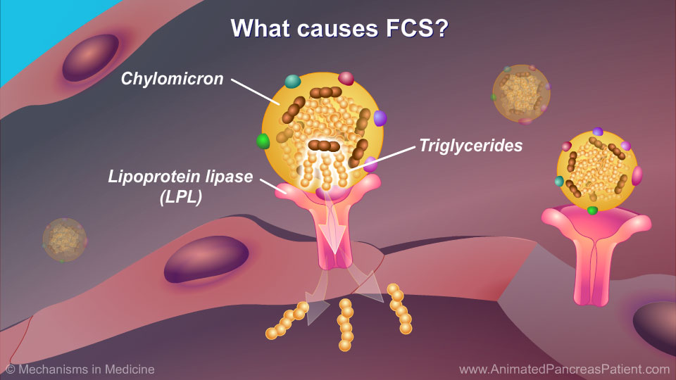 What causes FCS? - 2