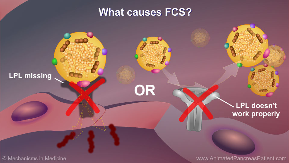 What causes FCS? - 3