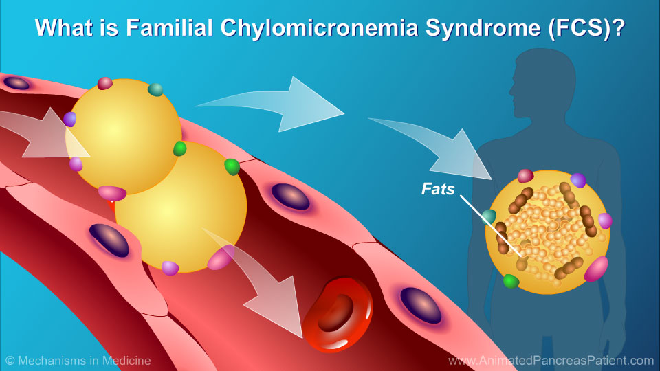 What is Familial Chylomicronemia Syndrome (FCS)?