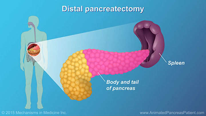 Origen emocional del cancer de pancreas